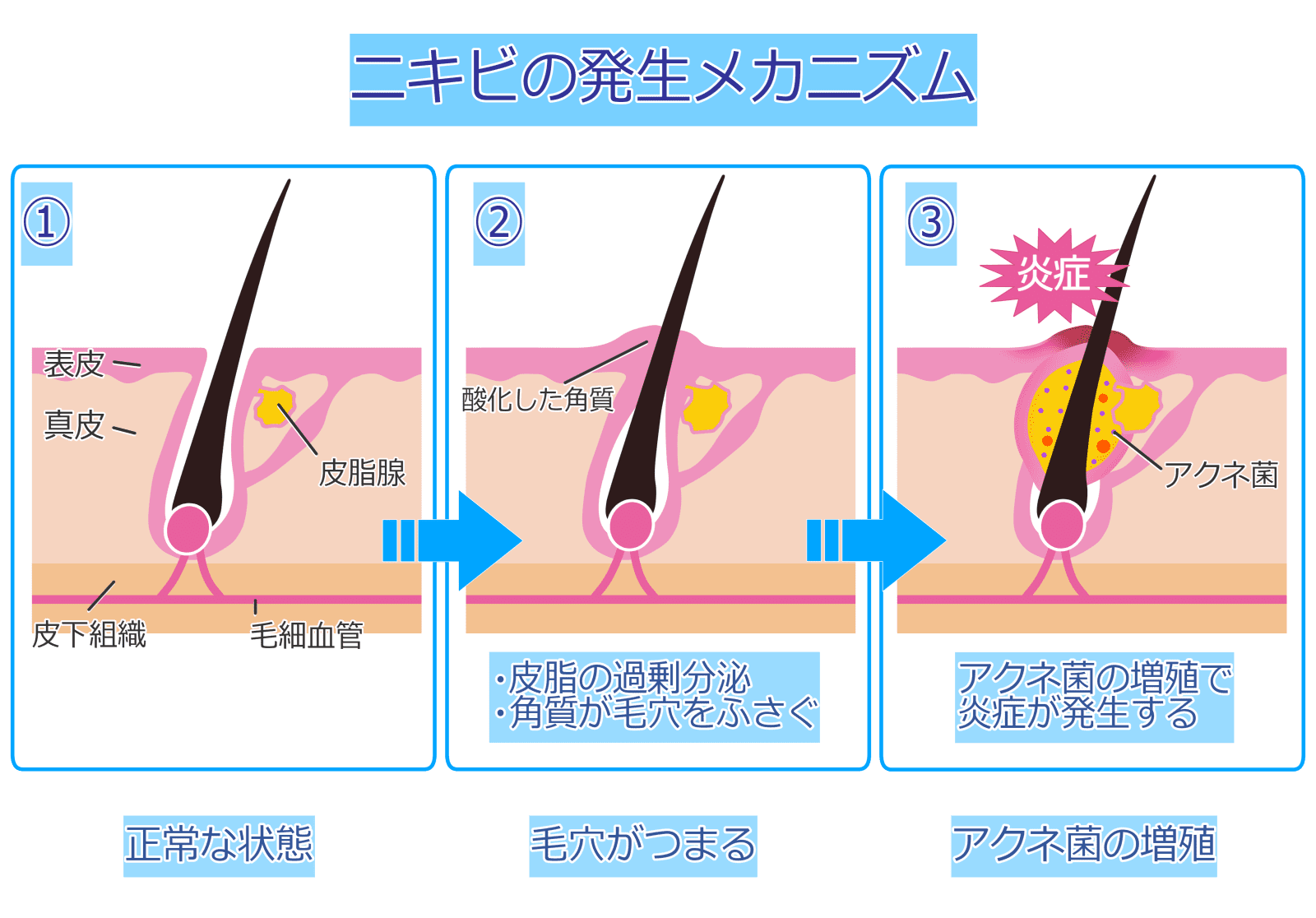 ニキビの原因